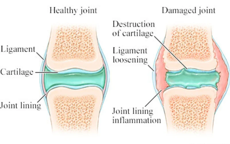 Comparison infographic showing healthy joint with synovial fluid versus damaged arthritic joint with depleted fluid