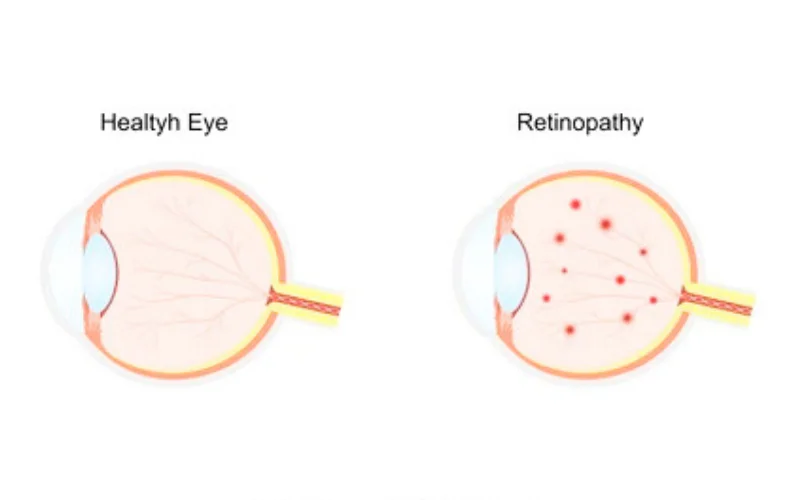 Detailed eye anatomy comparison showing healthy retina and macula versus damaged eye with inflammation and oxidative stress